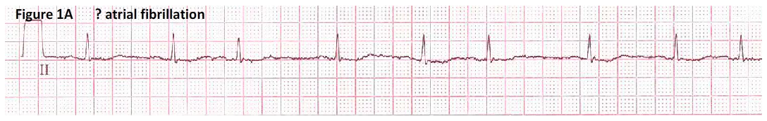 Afib Ekg Chart