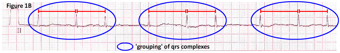 Afib Ekg Chart