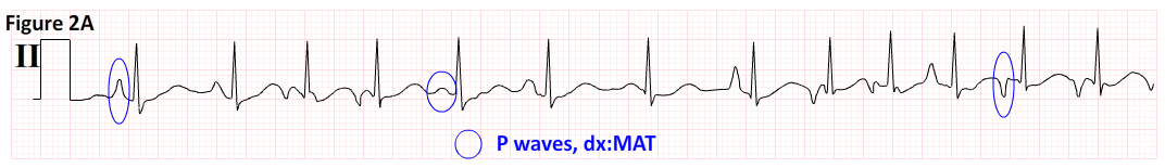 Afib Ekg Chart