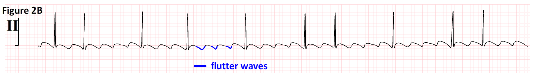 Afib ekg strip