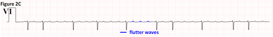 Afib Ekg Chart