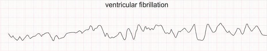 hyperkalemia5