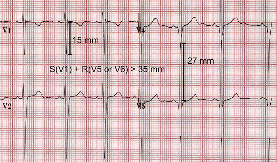 Lese en ung persons EKG - Topp 5 tips (2023)